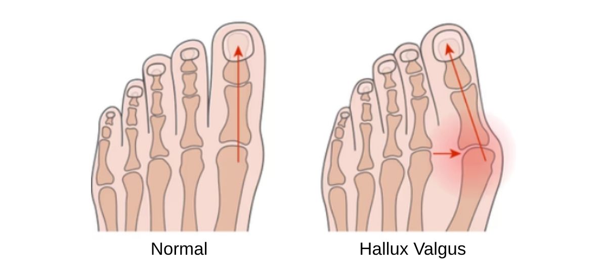 Hallux Valgus